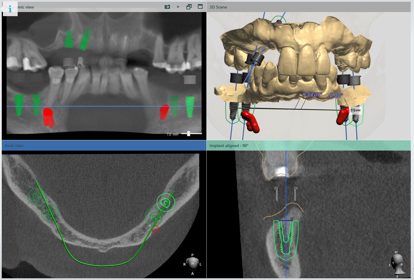 Dental Implant Surgical Guide PROCraft Dental Lab